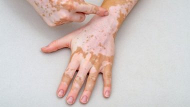 Na UFG: Cientistas avançam em pesquisas de medicamento natural contra o vitiligo