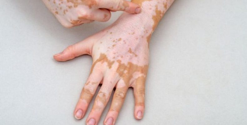 Na UFG: Cientistas avançam em pesquisas de medicamento natural contra o vitiligo